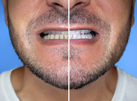 Bright, confident smile after professional whitening